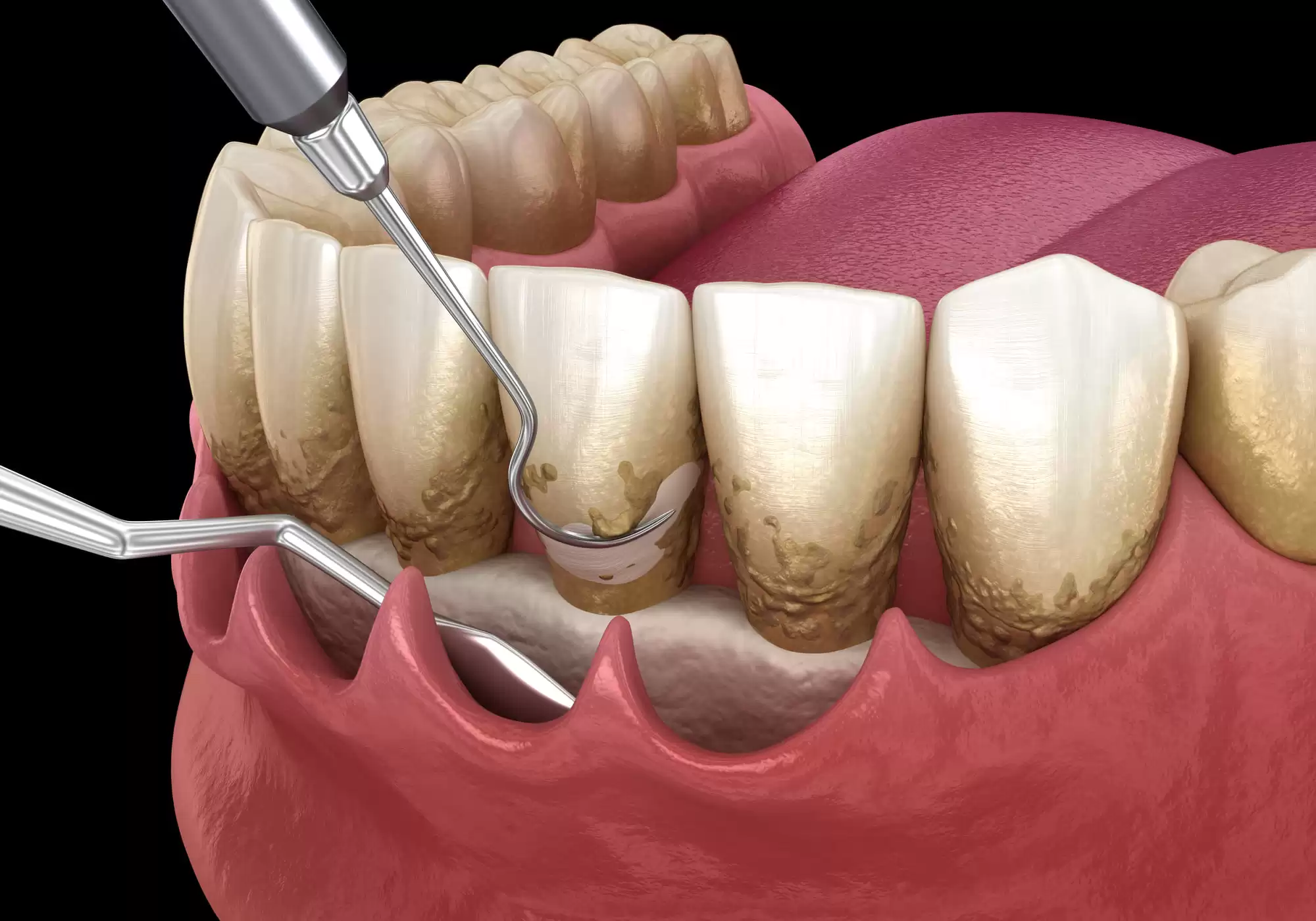 Dente Raspado ¿Qué es un Raspado Dental? - Consulta.Dental