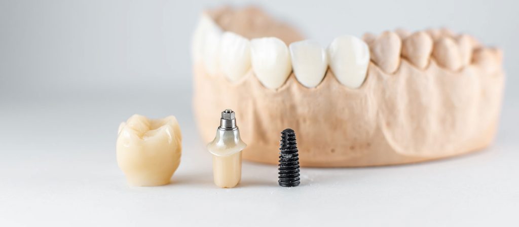 implantes dentales
