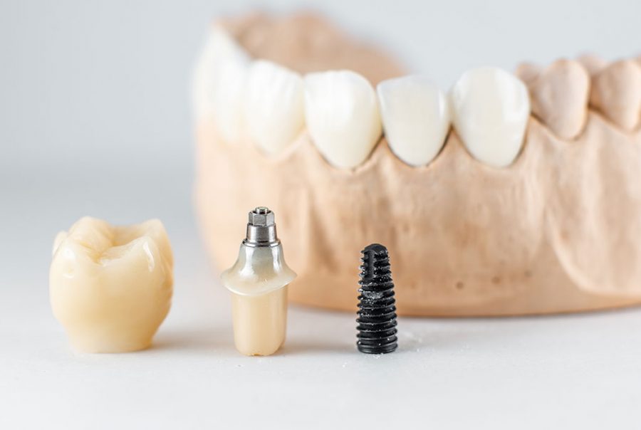 implantes dentales
